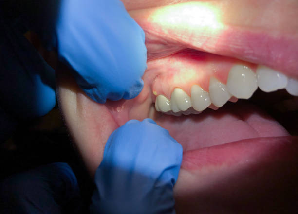 Best Emergency Dental Care for Broken or Chipped Teeth in Red Chute, LA